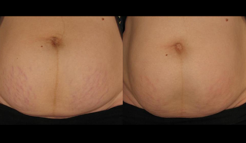 rf stretch mark removal treatment before after mississauga oakville